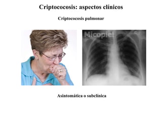 Criptococosis: aspectos clínicos
Criptococosis pulmonar
Asintomática o subclínica
 