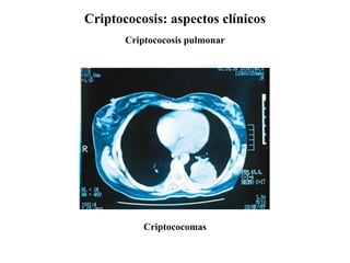 Criptococosis: aspectos clínicos
Criptococosis pulmonar
Criptococomas
 