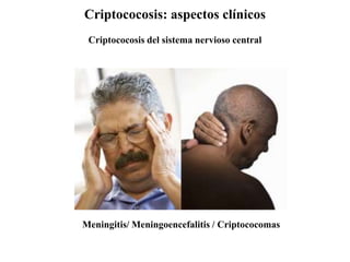 Criptococosis: aspectos clínicos
Criptococosis del sistema nervioso central
Meningitis/ Meningoencefalitis / Criptococomas
 