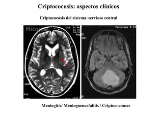 Criptococosis: aspectos clínicos
Criptococosis del sistema nervioso central
Meningitis/ Meningoencefalitis / Criptococomas
 