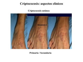 Criptococosis: aspectos clínicos
Criptococosis cutánea
Primaria / Secundaria
 