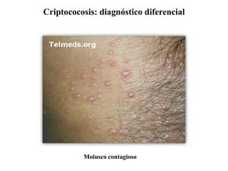 Criptococosis: diagnóstico diferencial
Molusco contagioso
 