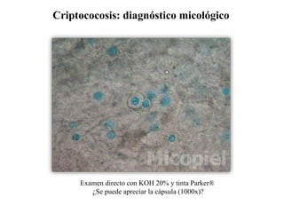 Criptococosis: diagnóstico micológico
Examen directo con KOH 20% y tinta Parker®
¿Se puede apreciar la cápsula (1000x)?
 