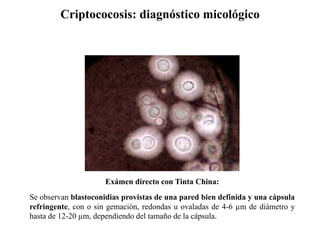 Criptococosis: diagnóstico micológico
Exámen directo con Tinta China:
Se observan blastoconidias provistas de una pared bien definida y una cápsula
refringente, con o sin gemación, redondas u ovaladas de 4-6 µm de diámetro y
hasta de 12-20 µm, dependiendo del tamaño de la cápsula.
 