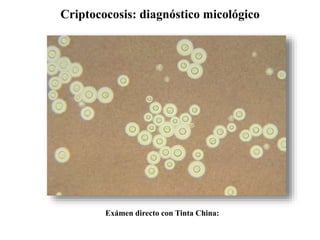 Criptococosis: diagnóstico micológico
Exámen directo con Tinta China:
 
