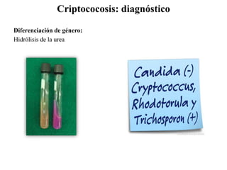 Criptococosis: diagnóstico
Diferenciación de género:
Hidrólisis de la urea
 
