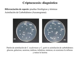 Criptococosis: diagnóstico
Diferenciación de especie: pruebas fisiológicas y térmicas
Asimilación de Carbohidratos (Auxanograma):
Patrón de asimilación de C. neoformans y C. gattii es asimilación de carbohidratos:
glucosa, galactosa, sacarosa, maltosa, trehalosa, ramnosa; en ocasiones la rafinosa
y nunca la lactosa
 