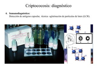 Criptococosis: diagnóstico
4. Inmunodiagnóstico:
Detección de antígeno capsular, técnica aglutinación de partículas de latex (LCR).
 