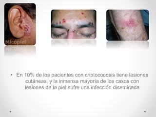 Cryptococcus | PPTX