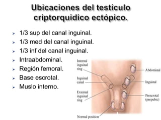 Ubicaciones del testículo criptorquidico ectópico.1/3 sup del canal inguinal.