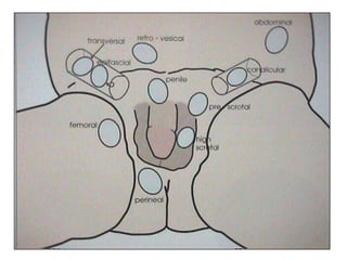 1/3 inf del canal inguinal.