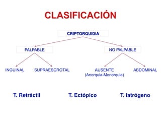 +TESTÍCULO RETRÁCTIL“LA MAYORÍA DE NIÑOS CON  SUPUESTA ECTOPÍATIENEN SÓLO UN TESTÍCULO RETRÁCTIL POR REFLEJO CREMASTERIANO ACTIVO ”NO TRATAREXCEPTO: POSTPUBERALóPÉRDIDA DE TAMAÑO