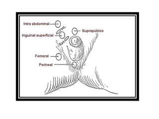 CRIPTORQUIDIA UNILATERAL