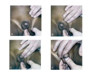 33% de los prematuros.	      