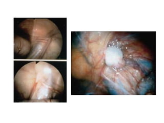 ANOMALIAS ASOCIADASANOMALIAS DE LA PARED ABDOMINAL:Síndrome de Prunne-Belly.ANOMALIAS  CROMOSOMICAS:Síndrome de Kallmann.ANOMALIAS DE LAS VIAS ESPERMATICAS:Epididimo.MALFORMACIONES URINARIAS:Hipospadias, válvulas uretrales posteriores.
