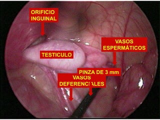 CLASIFICACIÓNCRIPTORQUIDIAPALPABLENO PALPABLEINGUINALSUPRAESCROTALAUSENTE(Anorquia-Monorquia)ABDOMINALT. Retráctil                   T. Ectópico 	       T. Iatrógeno  