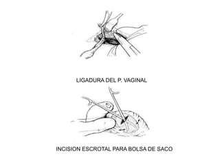 COMPLICACIONES INFERTILIDAD6% Hombres estériles        	Historia Criptorquidia no tratada u 				orquiopexia.Paternidad        			62% Criptorquidia Bilateral.	           			89.5% Criptorquidia Unilateral.Espermatograma Normal	20% Criptorquidia Bilateral.					75% Criptorquidia Unilateral.Localización del testiculo             Intraabdominal.MecanismoAutoinmuneTesticulo Contralateral.