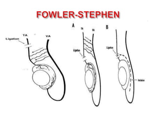 TRATAMIENTOHORMONAL:Análogos agonistas de GnRH (Buserelina, Nafarelina).↑ Liberación de FSH-LH -> ↑ Esteroideogénesis gonadal.Disponible en espray nasal (únicamente Europa).Esquema: 1.2 mg/d por 4 semanas.EA:↑ Andrógenos: ↑ Tamaño testicular y peneano, eritema escrotal o erecciones.(-) GnRH que con hCG.