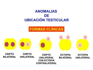 ++++---+-+CRIPTOBILATERALCRIPTOUNILATERALCRIPTOUNILATERALCON ECTOPIACONTRALATERALECTOPIABILATERALECTOPIAUNILATERALANOMALIAS DEUBICACIÓN TESTICULARFORMAS CLÍNICAS