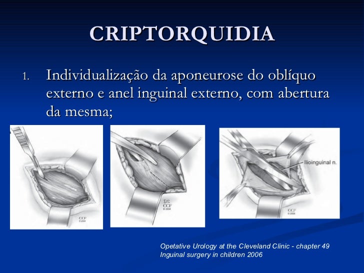 Criptorquidia