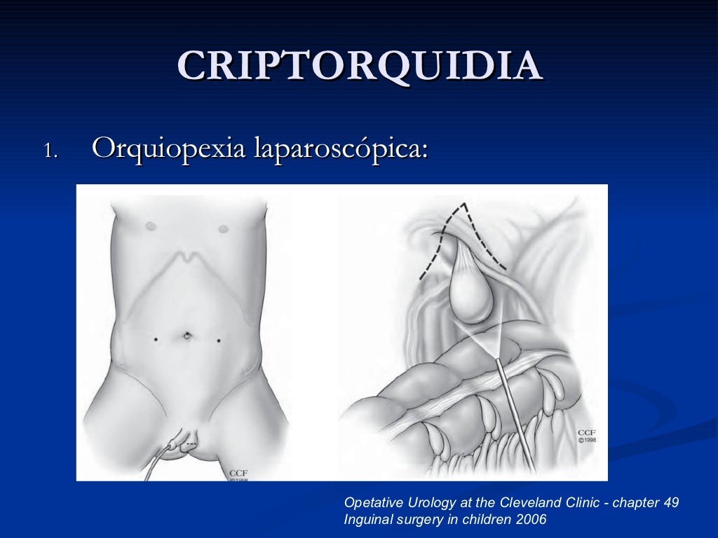 Criptorquidia