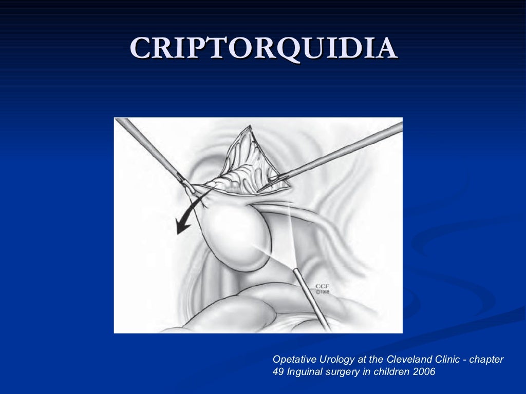 Criptorquidia