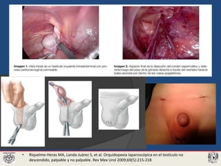 • Riquelme-Heras MA, Landa-Juárez S, et al. Orquidopexia laparoscópica en el testículo no
descendido, palpable y no palpable. Rev Mex Urol 2009;69(5):215-218
 