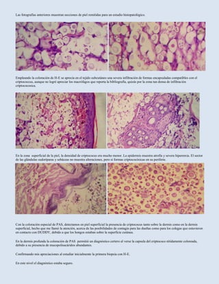 Las fotografías anteriores muestran secciones de piel remitidas para un estudio histopatológico.
Empleando la coloración de H-E se aprecia en el tejido subcutáneo una severa infiltración de formas encapsuladas compatibles con el
criptococcus, aunque no logré apreciar los macrófagos que reporta la bibliografía, quizás por la zona tan densa de infiltración
criptococosica.
En la zona superficial de la piel, la densidad de criptococus era mucho menor. La epidermis muestra atrofia y severa hiperemia. El sector
de las glándulas sudoríparas y sebáceas no muestra alteraciones, pero si formas criptococósicas en su periferie.
Con la coloración especial de PAS, detectamos en piel superficial la presencia de criptococus tanto sobre la dermis como en la dermis
superficial, hecho que me llamó la atención, acerca de las posibilidades de contagio para las dueñas como para los colegas que estuvieron
en contacto con DUDDY, debido a que los hongos estaban sobre la superficie cutánea.
En la dermis profunda la coloración de PAS permitió un diagnóstico certero al verse la capsula del criptococo nítidamente coloreada,
debido a su presencia de mucopolisacáridos abundantes.
Confirmando mis apreciaciones al estudiar inicialmente la primera biopsia con H-E.
En este nivel el diagnóstico estaba seguro.
 