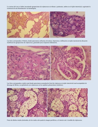 Lo curioso del caso es haber encontrado agrupaciones de criptococus en riñones y pulmones, ambos en el tejido intersticial, sugiriendo la
existencia de una diseminación vía hematógena.
Las fotos corresponden a Pulmón, donde apreciamos enfisemas alveolares, hiperemia e infiltración en tejido inersticial de ubicación
multifocal de agrupaciones de criptococus, generando poca respuesta inflamatoria.
Las fotos corresponden a tejido renal donde apreciamos acumulación focal de criptoccus en tejido intersticial renal acompañado de
descarga de fibrina y un glomérulo con criptococus en los capilares glomerulares (émbolos).
Fotos de túbulos renales destruidos, de los cuales solo queda la imagen periférica y el interior está invadido de criptococus.
 