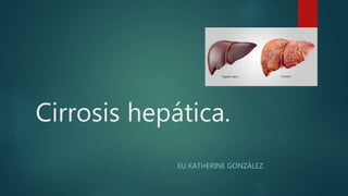 Cirrosis hepática.
EU KATHERINE GONZÁLEZ
 