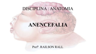 ANENCEFALIA
DISCIPLINA : ANATOMIA
Prefº. RAILSON RALL
 