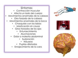 Síntomas:
• Contracción muscular
• Afecta un lado del cuerpo
• Movimientos anormales de la cabeza
• Giro forzado de la cabeza
• Movimientos anormales de la boca
• Chasquido con los labios
• Masticación sin causa
• Giros forzados de los ojos
• Entumecimiento
• Alucinaciones
• Dolor o molestia abdominal
• Sudoración
• Náuseas
• Pupilas dilatadas
• Enrojecimiento de la cara
 