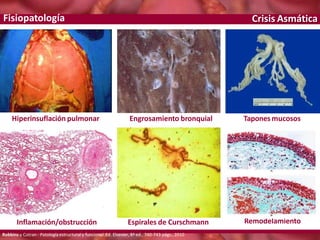 Crisis Asmática
Hiperinsuflación pulmonar Engrosamiento bronquial Taponesmucosos
Inflamación/obstrucción Espirales de Curschmann
Robbins y Cotran - Patología estructural y funcional.Ed. Elsevier, 8ª ed., 740-743 págs., 2010
Remodelamiento
Fisiopatología
 