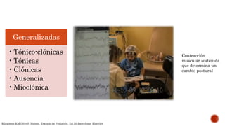 Generalizadas
•Tónico-clónicas
•Tónicas
•Clónicas
•Ausencia
•Mioclónica
Contracción
muscular sostenida
que determina un
cambio postural
Kliegman RM.(2016). Nelson. Tratado de Pediatría. Ed.20.Barcelona: Elsevier.
 