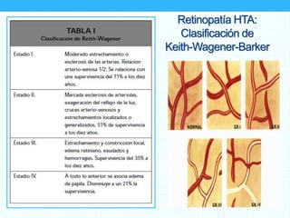 Retinopatía HTA:
Clasificación de
Keith-Wagener-Barker
 