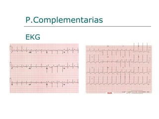 P.Complementarias

EKG
 