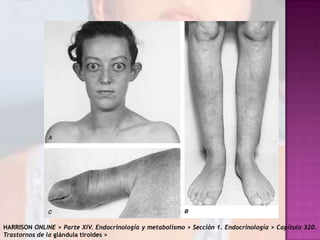 HARRISON ONLINE > Parte XIV. Endocrinología y metabolismo > Sección 1. Endocrinología > Capítulo 320.
Trastornos de la glándula tiroides >

 