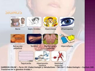 Bocio

Soplo tiroideo

Hipercinesia

Oftalmopatía

Retracción
palpebral

Temblor

Piel húmeda y
caliente

Hiperreflexia

Taquicardia

Hipertensión
sistólica

Debilidad
muscular

HARRISON ONLINE > Parte XIV. Endocrinología y metabolismo > Sección 1. Endocrinología > Capítulo 320.
Trastornos de la glándula tiroides >

 