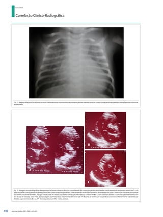 Correlação Clínico-Radiográfica
Edmar Atik
Arq Bras Cardiol 2007; 88(6) : 693-695
Fig. 1 - Radiografia de tórax salienta os sinais habitualmente encontrados na transposição das grandes artérias, como forma cardíaca ovalada e trama vascular pulmonar
aumentada.
Fig. 2 - Imagens ecocardiográficas demonstram os sinais clássicos do criss-cross através de comunicação do átrio direito com o ventrículo esquerdo (setas) em C e do
átrioesquerdocomoventrículodireito(setas)emB,emcorteslongitudinais,caracterizandoaindaadiscordânciaatrioventricular,comoventrículoesquerdoàesquerda
e o ventrículo direito à direita. A dupla via de saída do ventrículo direito com duplo infundíbulo é nítida em B e A, com a aorta à direita. A comunicação interventricular
era de via de entrada, vista em C, e a bandagem pulmonar está claramente demonstrada em A (seta). O ventrículo esquerdo se posiciona inferiormente e o ventrículo
direito, superiormente (B e C). TP - tronco pulmonar; VAo - valva aórtica.
694
 