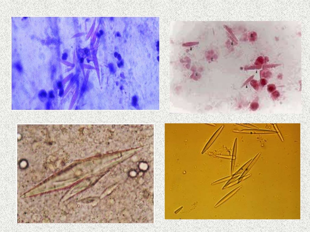 Cristales Charcot-Leyden.