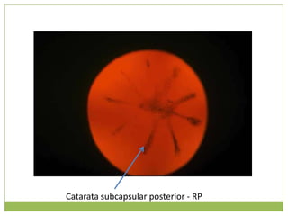 Catarata subcapsular posterior - RP<br />