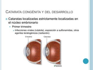 CATARATA CONGÉNITA Y DEL DESARROLLO
   Cataratas localizadas estrictamente localizadas en
    el núcleo embrionario
       Primer trimestre
           Infecciones virales (rubéola), exposición a sulfonamidas, otros
            agentes teratogénicos (radiación)
 