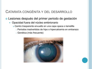 CATARATA CONGÉNITA Y DEL DESARROLLO
   Lesiones después del primer periodo de gestación
       Opacidad fuera del núcleo embrionario
           Centro trasparente envuelto en una capa opaca o lamelilla
              Periodos inadvertidos de hipo o hipercalcemia en embarazo

              Genética (más frecuente)
 