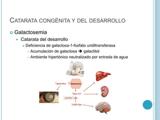 CATARATA CONGÉNITA Y DEL DESARROLLO
   Galactosemia
       Catarata del desarrollo
           Deficiencia de galactosa-1-fosfato uridiltransferasa
              Acumulación de galactosa  galactitol

              Ambiente hipertónico neutralizado por entrada de agua
 