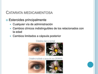 CATARATA MEDICAMENTOSA
   Esteroides principalmente
     Cualquier vía de administración
     Cambios clínicos indistinguibles de los relacionados con
      la edad
     Cambios limitados a cápsula posterior
 