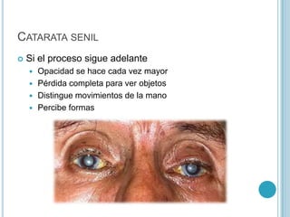 CATARATA SENIL
   Si el proceso sigue adelante
     Opacidad se hace cada vez mayor
     Pérdida completa para ver objetos
     Distingue movimientos de la mano
     Percibe formas
 