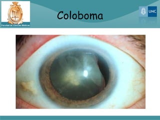 Coloboma
 