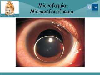 Microfaquia-
Microesferofaquia
 