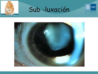 Sub -luxación
 