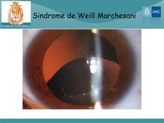 Sindrome de Weill Marchesani
 